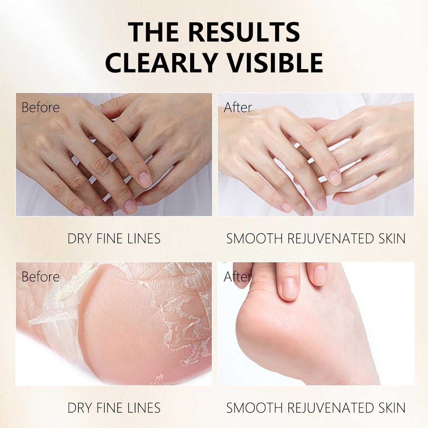 Hydrating Hand Foot Masks Set for Women Men,3 Pack Glove Mask for Dry Hand & 3 Pack Socks Mask for Dry Cracked Feet(Milk)