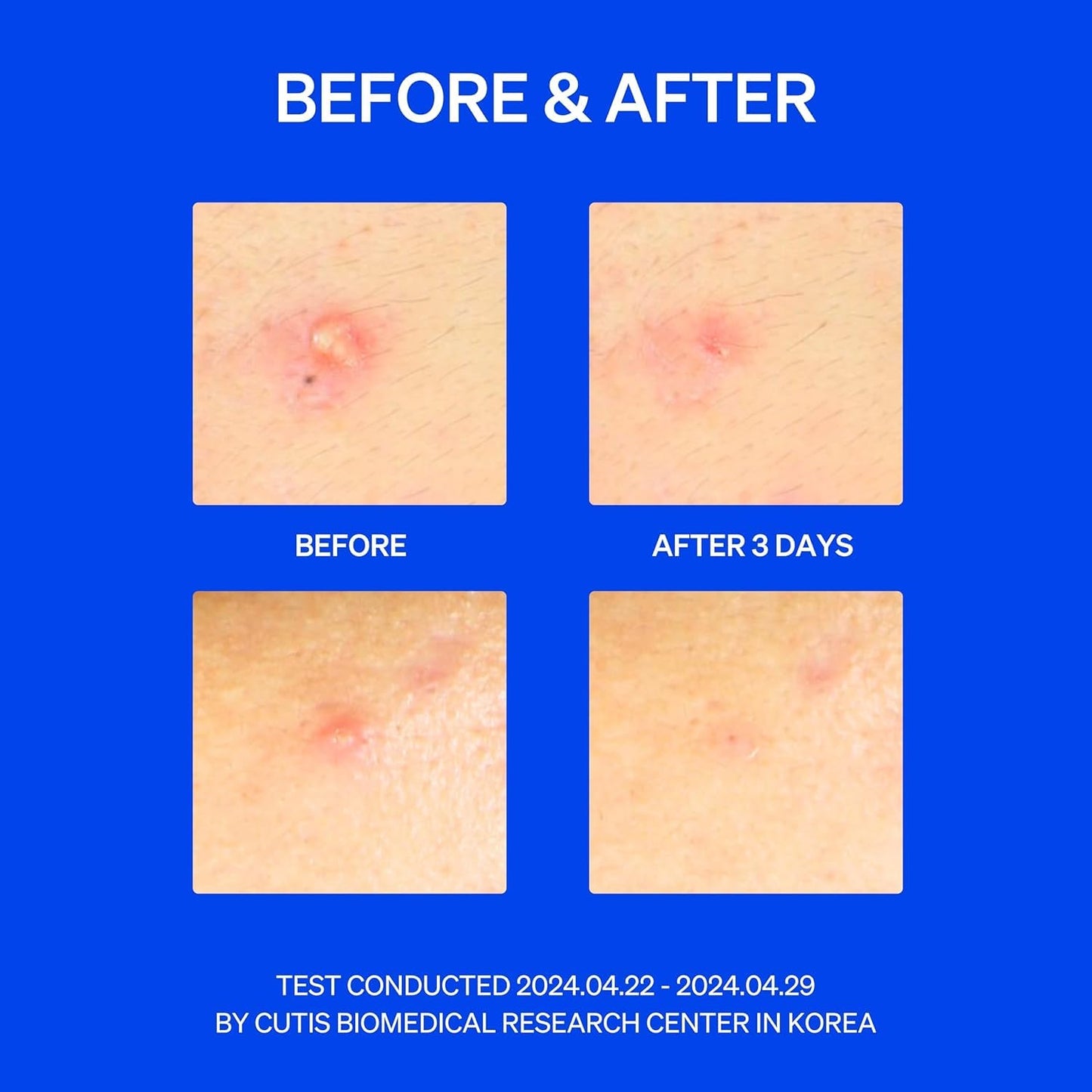 Right Away Thincognito Invisible Spot Patch - Absorbing Hydrocolloid Pimple Patch for Face, Blemishes, Zits, Acne, Breakouts Spot Treatment for Skin Care, 2 Sizes (42 Count)