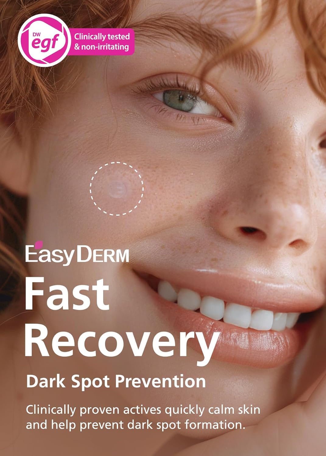 EasyDerm Real Calming Microdart Pimple Patches, Clear Micropoint | Niacinamide, Hyaluronic Acid, EGF Acne Dark Spot Care, K-beauty | 6 counts, Micro Piont length : 285μm