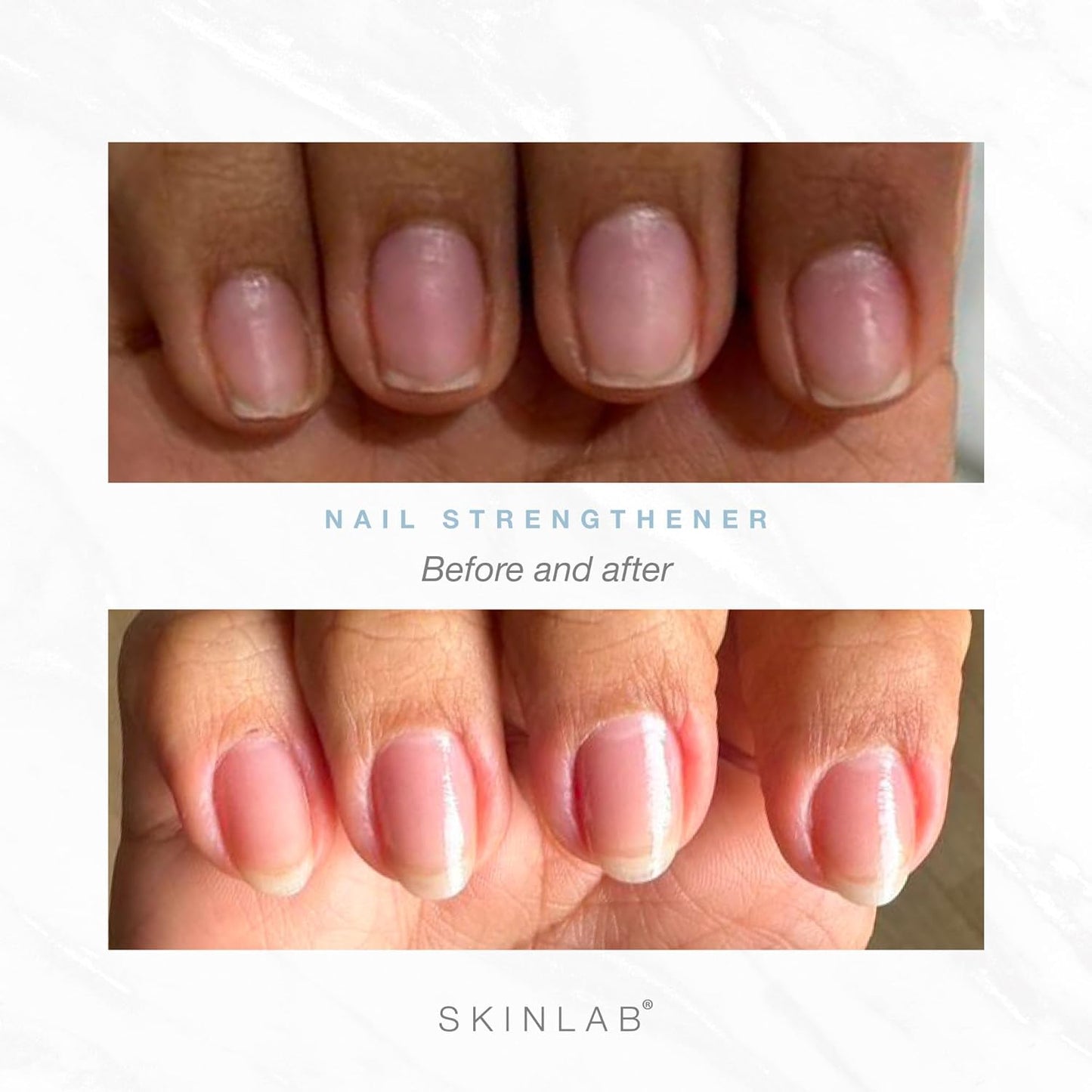 Skinlab’s Premium Nail Strengthening Serum – Boosts Nail Growth & Resilience – Stronger, Healthier, Longer Nails – 3 Month Supply – Dermatologist Tested – Hypoallergenic – Cruelty-Free & Paraben-Free
