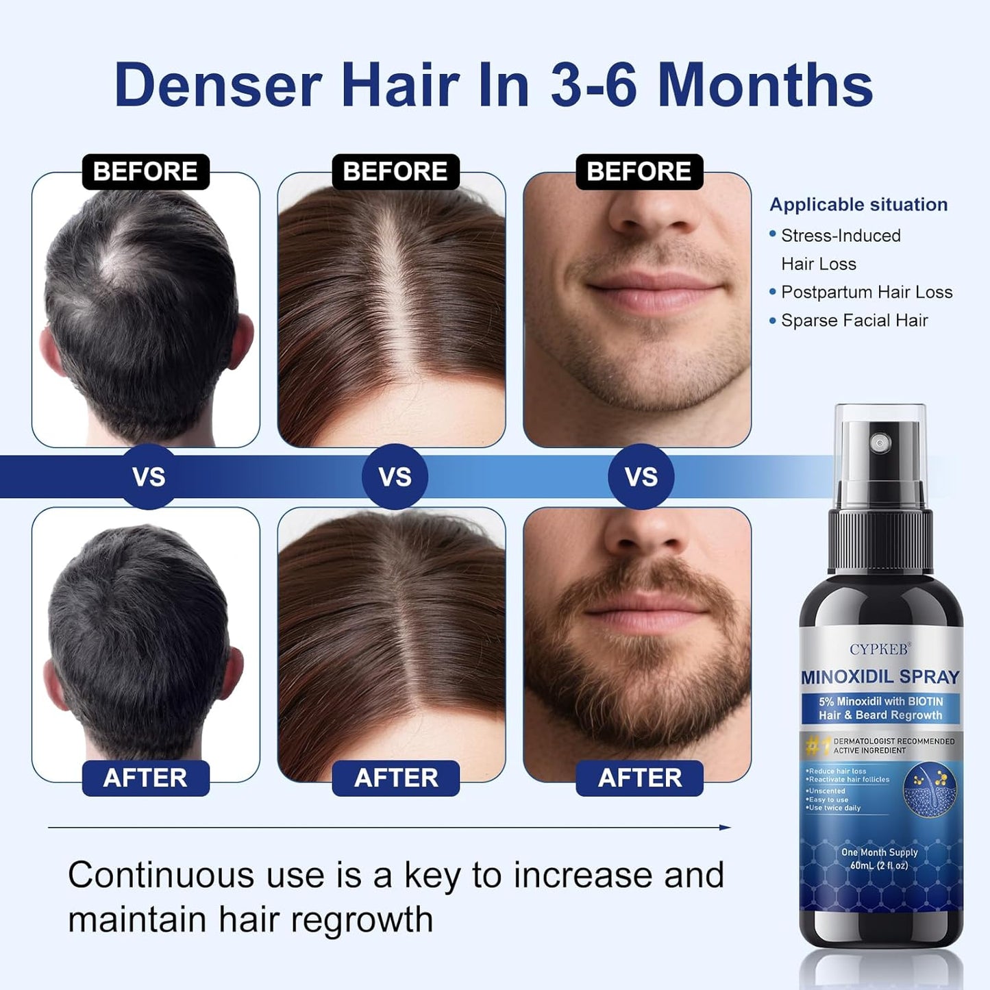 5% Minoxidil Spray for Men and Women, Infused with Biotin, Hair and Beard Regrowth Treatment, Extra Strength Treatment to Combat Hair Loss and Thinning, 4 Month Supply, 4 Bottles