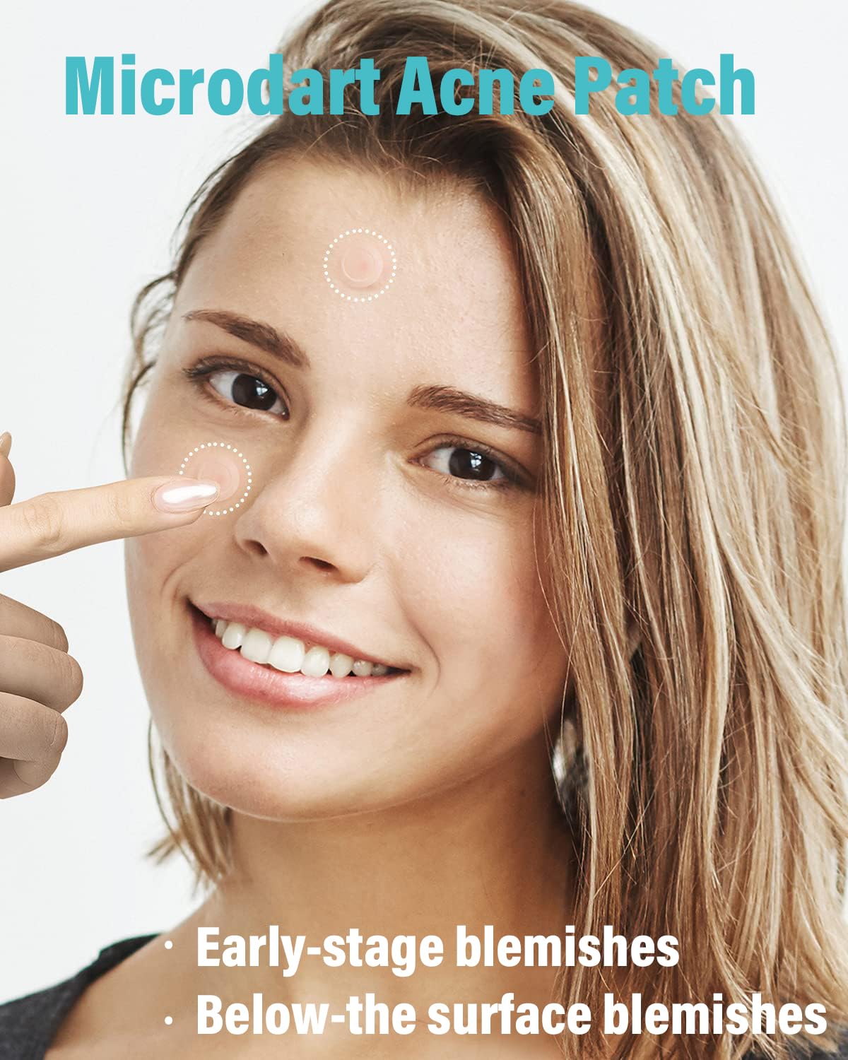 Microdart Acne Patch (36 Patches) - Hyaluronate Acid & Salicylic Acid Hydrocolloid Pimple Patch for Deep, Early and Hidden Blemishes (36 Count (Pack of 1))