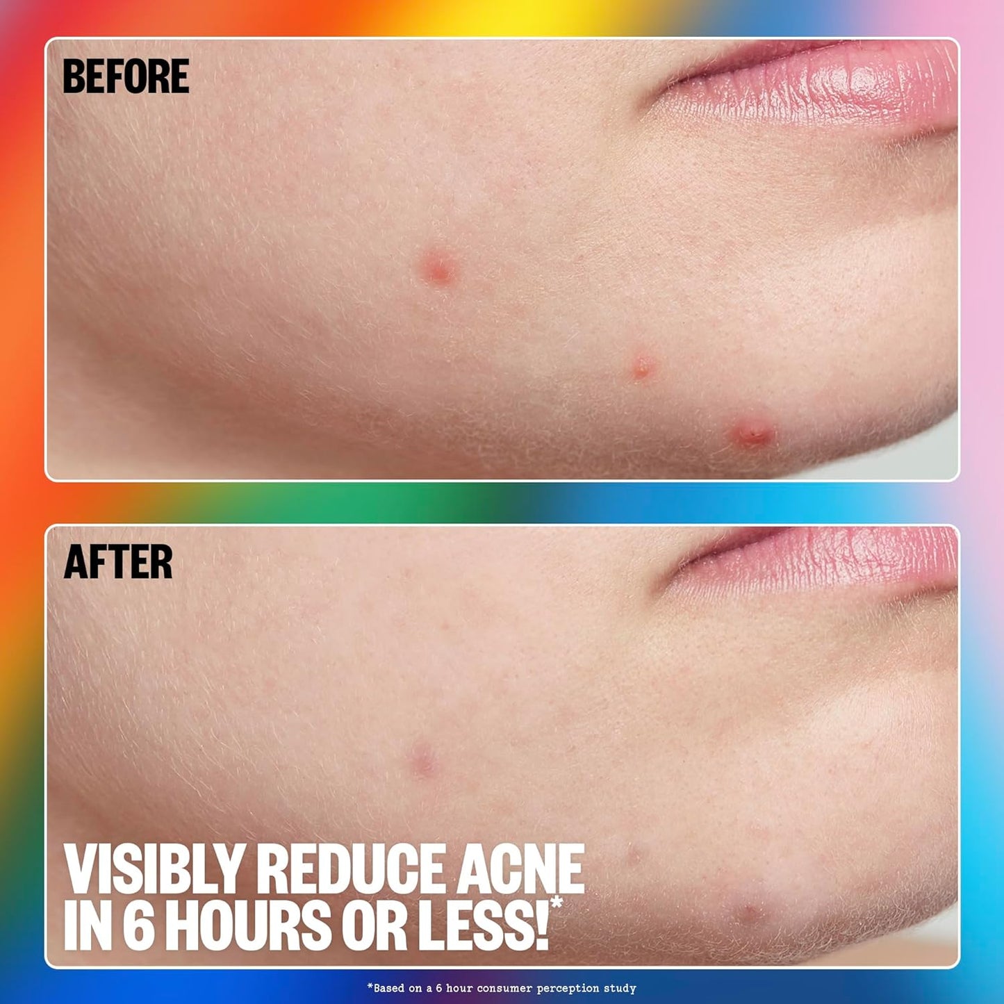 PEACE OUT Acne Healing Pride Dots Helps Clear Blemishes Overnight, Fast Acting Hydrocolloid Pimple Patches for Breakouts with Salicylic Acid, Retinol and Aloe Vera, Award Winning Skincare 16 Count