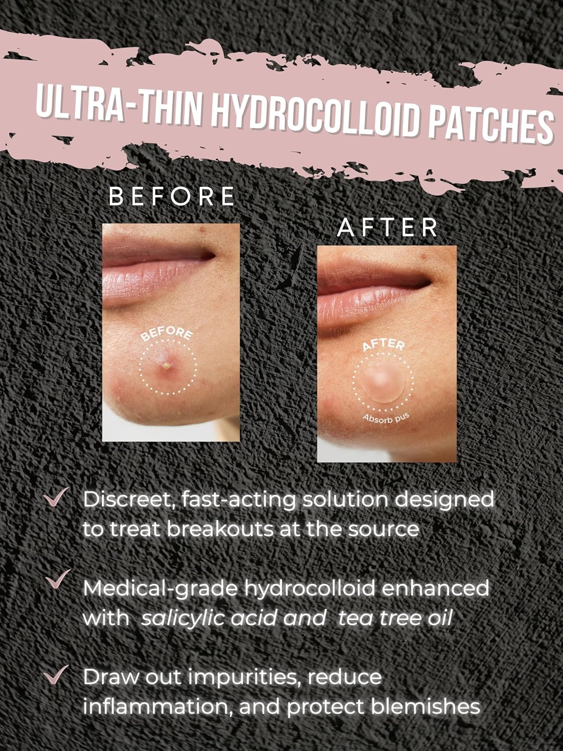 Acne Patch Ultra Thin Invisible Spot Cover- Fast Acting Hydrocolloid Pimple Patch with Salicylic Acid, Centella Asiatica & Tea Tree Oil- 72 Ct. Effective Treatment Absorbs Zits and Blemishes